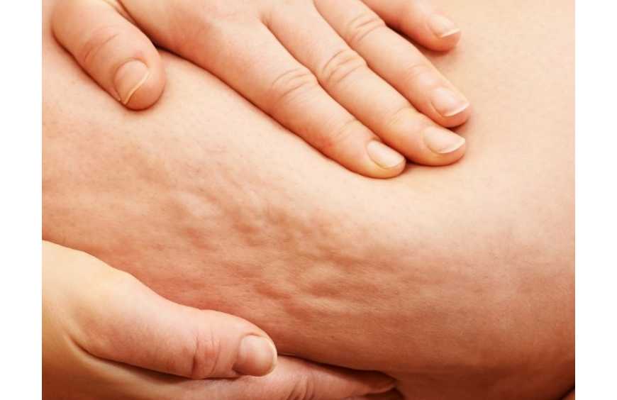 Coppettazione per la cellulite: come funziona e quando può essere utile